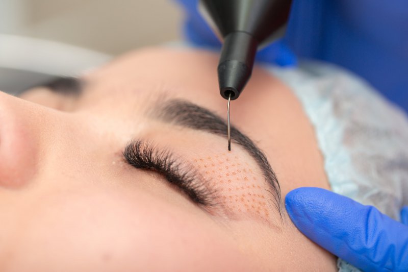 Plasma Fibroblast Upper Eye Lift 