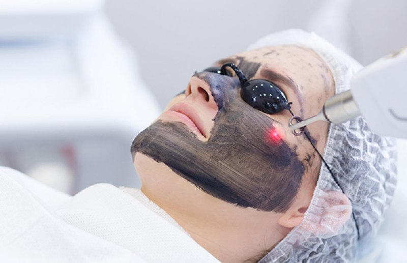 ADVENT 10: Carbon Laser Facial