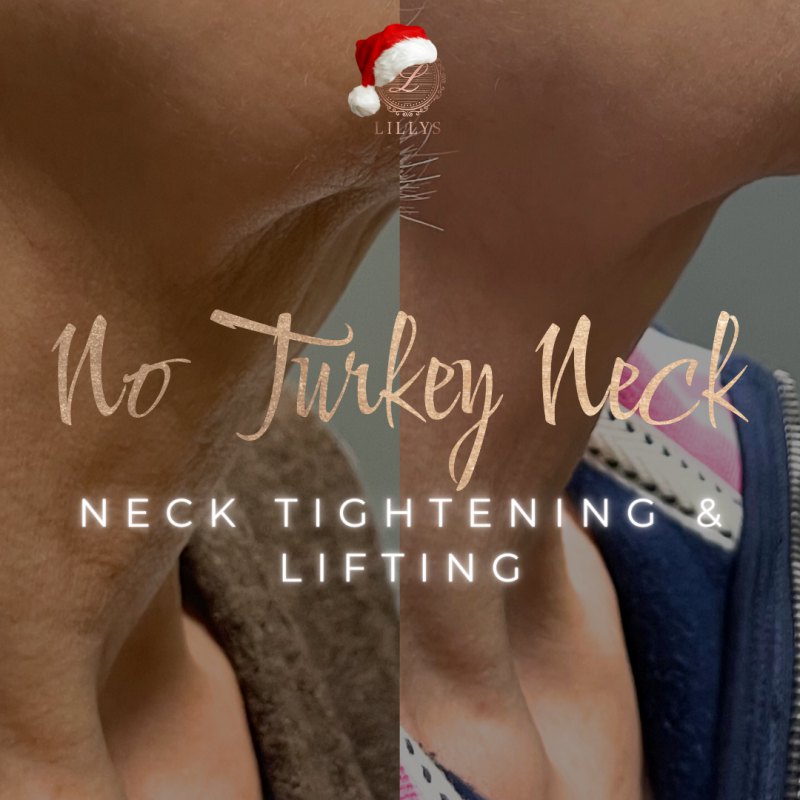 No Turkey Neck