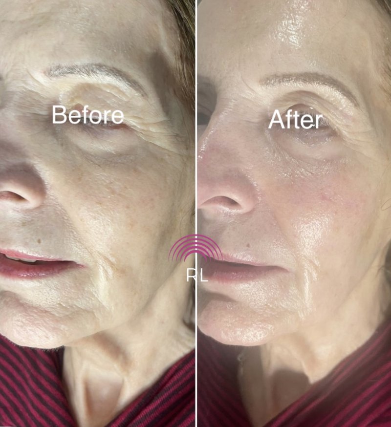 ADVENT: Full Face Nano RF Skin Tightening with Ice Globes