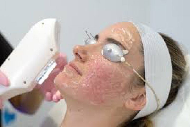 non surgical non invasive skin tightening  IPL LASER 