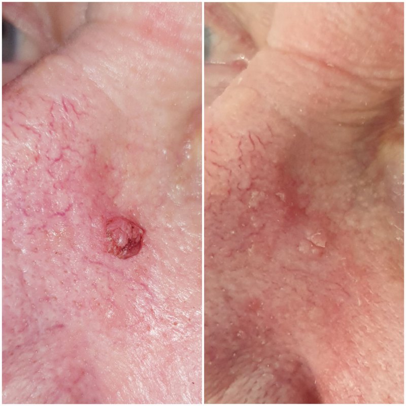 Cryopen Skin Blemish Removal