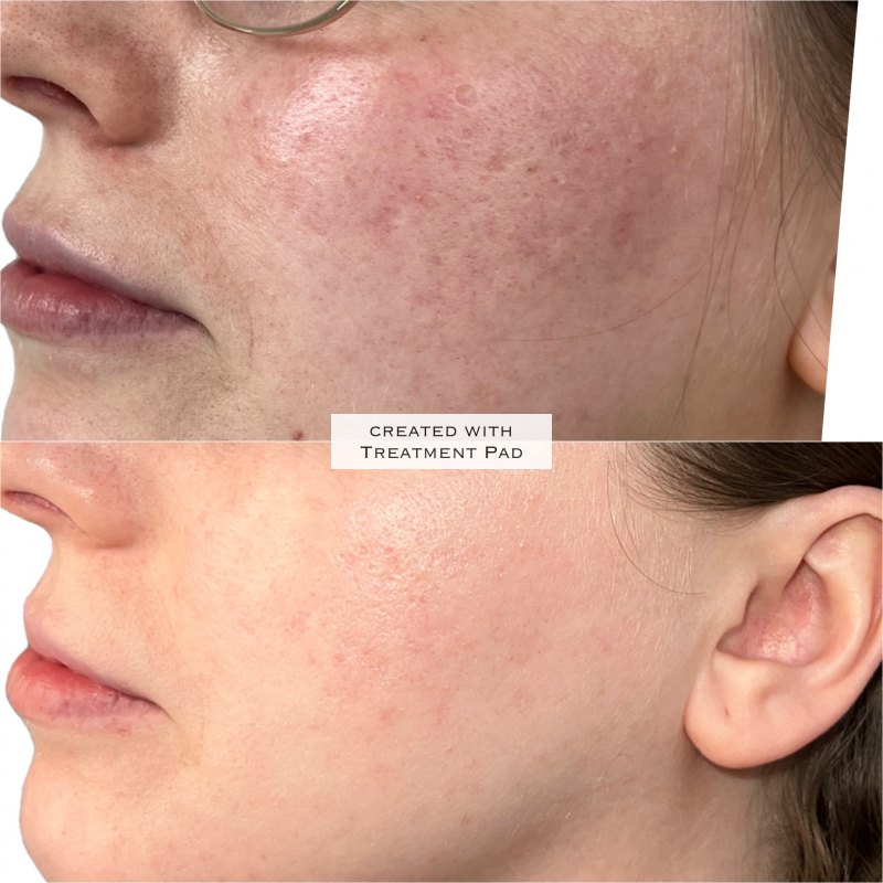 Microneedling x 3