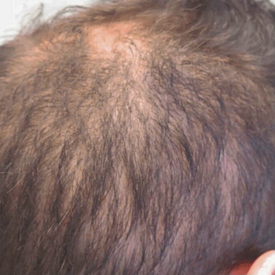 MODEL OFFER Hair Restoration 6 Month Treatment Programme inc Biotin