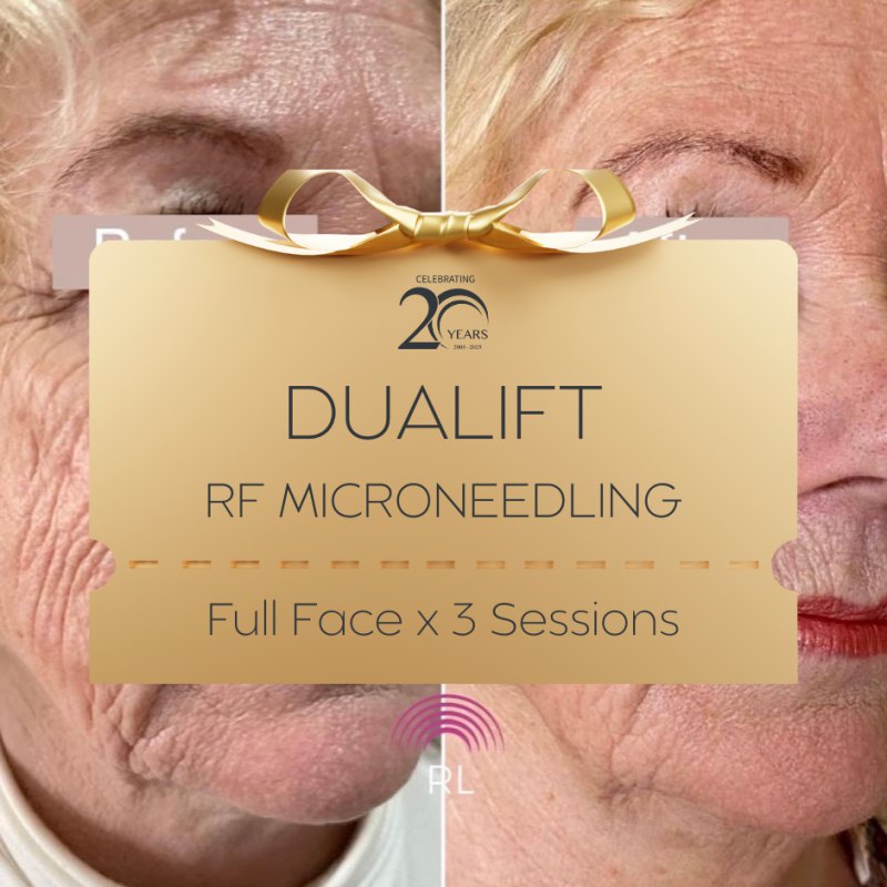 20YRS Dualift RF Microneedling (Morpheus8) Full Face x 3 sessions