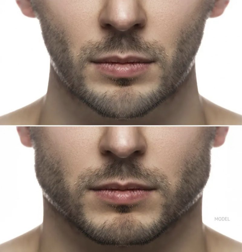 MODEL OFFER Gents Jawline Contour Package