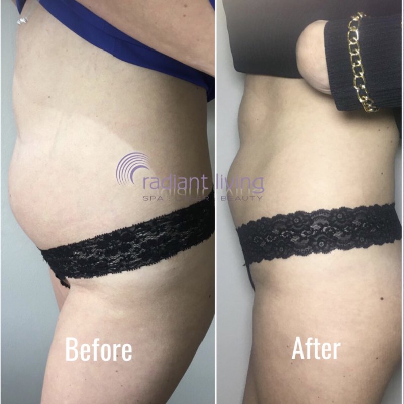 EASTER: 1 x Area of 3D Lipo Fat Freeze & EvoSculpt